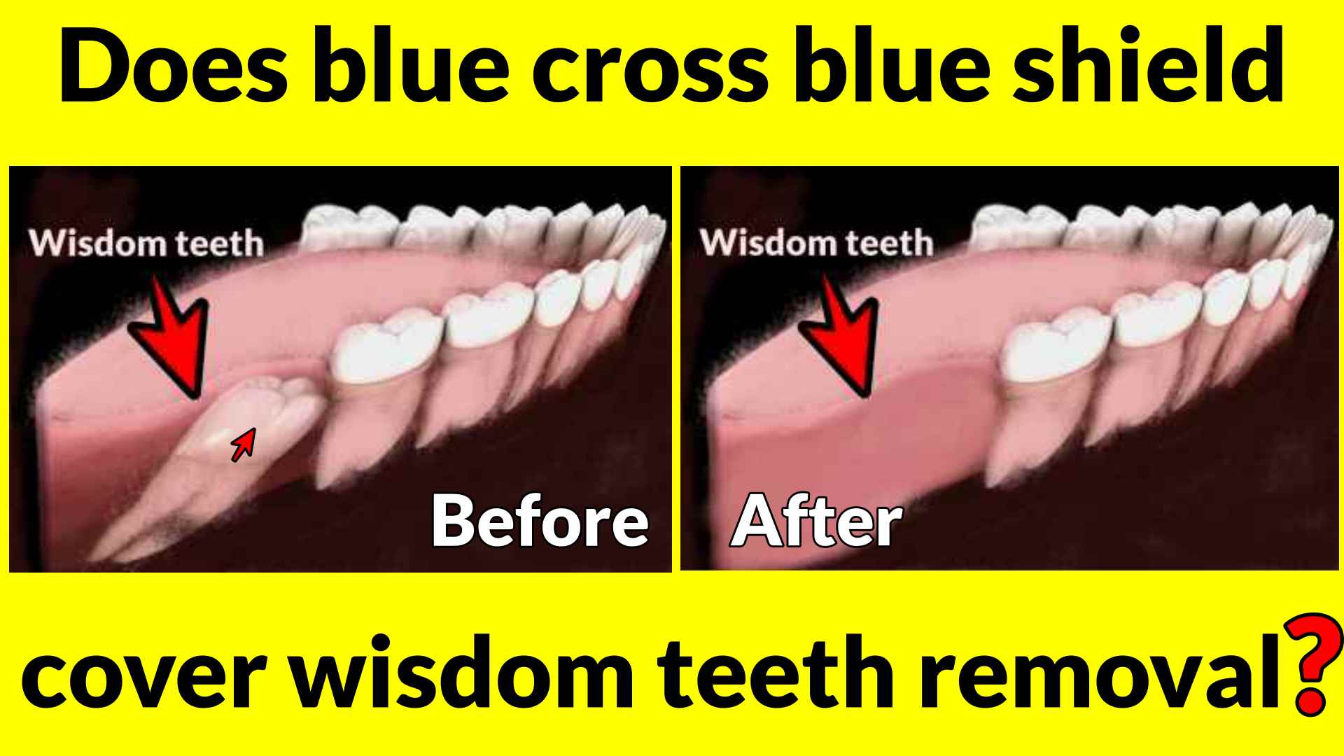 Does blue cross blue shield cover wisdom teeth removal