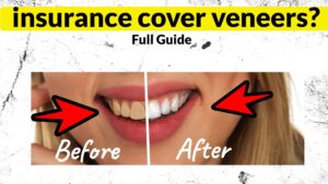 does insurance cover veneers