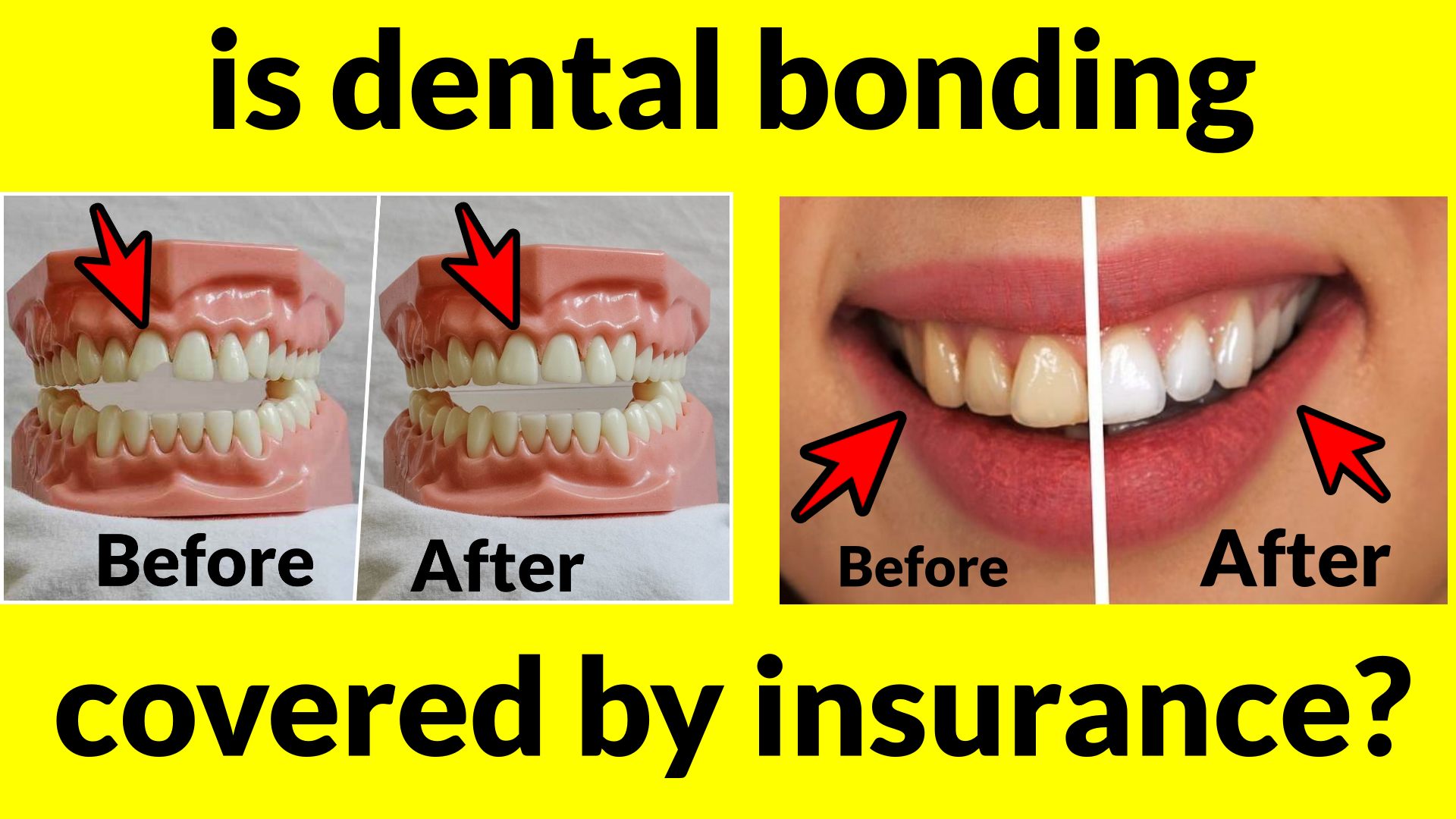 is dental bonding covered by insurance